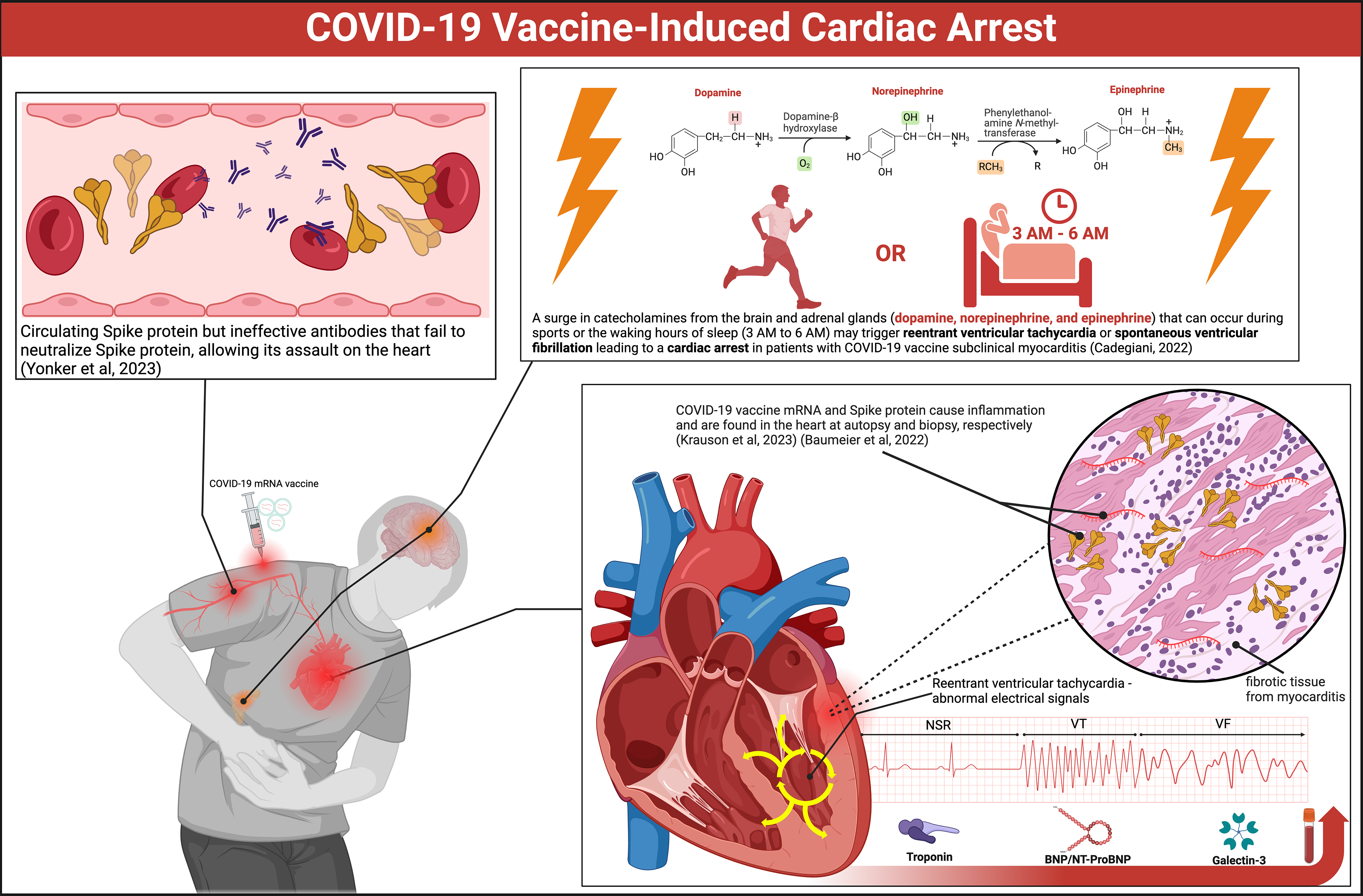 COVID-19 vaccine-induced cardiac arrest
